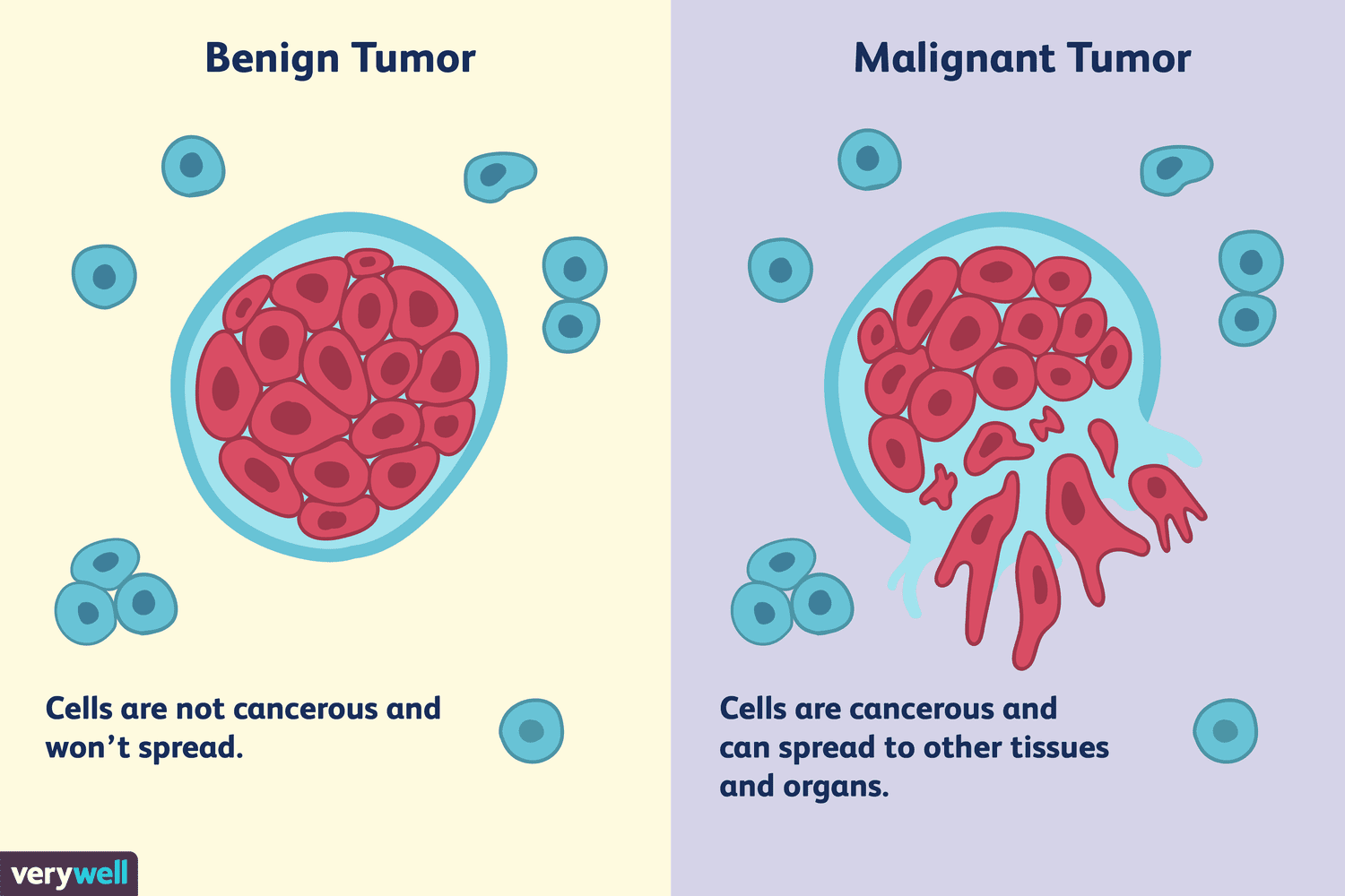 Breast Cancer Classification Using PCA Analysis
